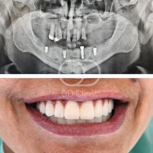 Зубные имплантаты