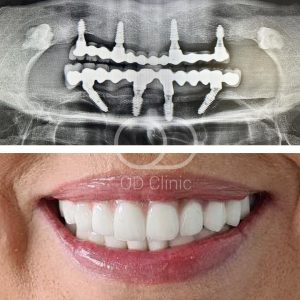 Diş implantları